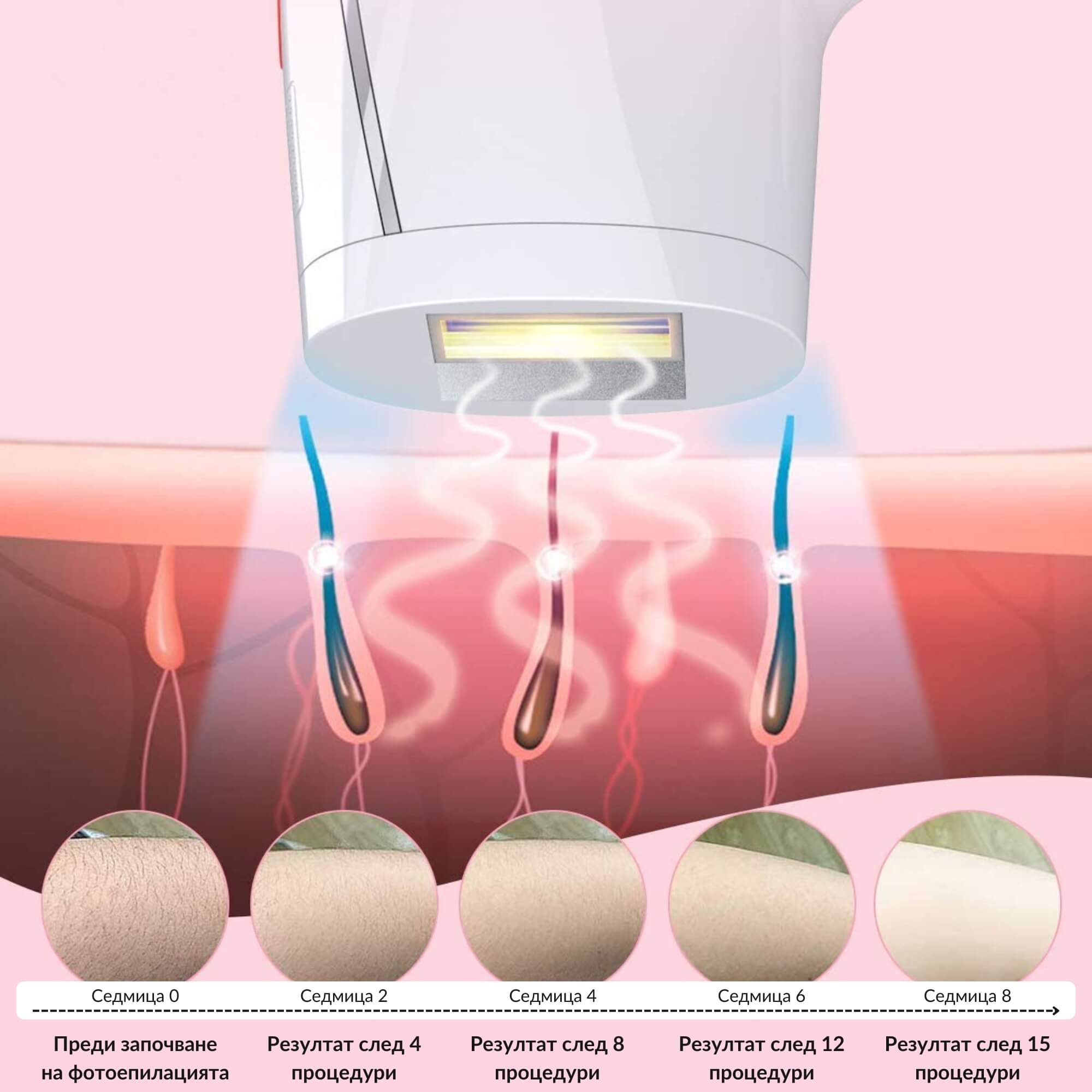 Схематично изображение, показващо ефекта от IPL фотоепилацията върху космените фоликули, с резултати след различни процедури през седмици.